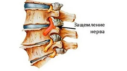 Jammed нерв в задната част на причините за това състояние и какво да правя