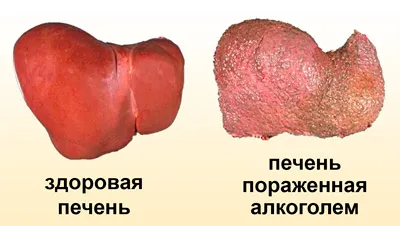 Алкохолни симптоми и признаци цироза, лечението и прогнозата