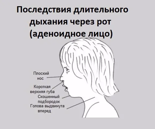 Аденоиди в носа при деца, лечение и симптоми, тайните на ефективно лечение (деца) Аденоиди в носа при деца, лечение и симптоми, тайните на ефективно лечение