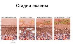 Алергии палми предизвика и лечение (лющене на кожата) Алергии върху дланите на причините и лечението