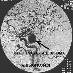 Мозъчна аневризма - причини, симптоми и лечение