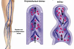 Болки в крака след петата
