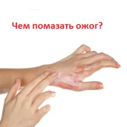 НатриВка горя в дома аптека и народни средства