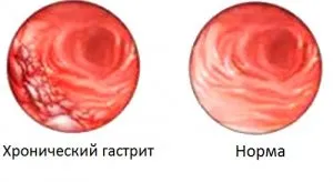 A kezelés hatékonyságát gyomorhurut savasságát népi jogorvoslati