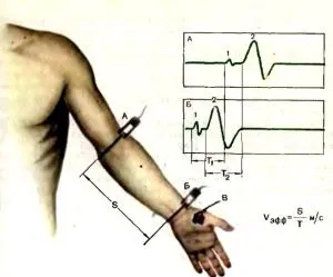 Electroneuromyography felső és alsó végtagok - hogyan és hol, hogy az ár