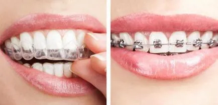 Rajtbírók értékeléseket Kappa az összehangolás a fogak (aligners vélemény szakemberek) Rajtbírók értékeléseket kappa a fogak igazítás