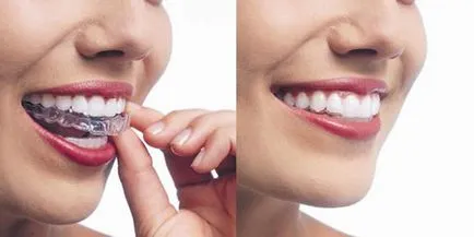 Aligner vonalba fogak leírása, képek előtt és után