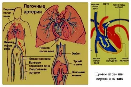 Embólia jeleket, az osztályozás, a különbségek embólia vérrög képződik, video (embólia) Embólia jeleket, az osztályozás, a különbségek embólia vérrög képződik, video