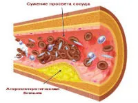 Какво е печатът на стените на аортата и аортната клапа