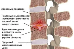 Какво е SHmorlja възли (всички от херния) Какво е SHmorlja възли