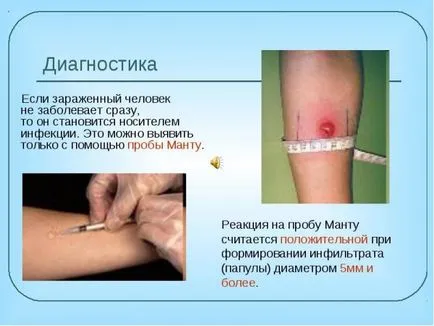 Защо Манту тест за туберкулоза диагноза