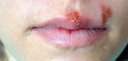 Херпес по лицето на лечение снимка у дома, бързо и ефективно