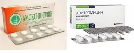 Язви в гърлото - причини и лечение на