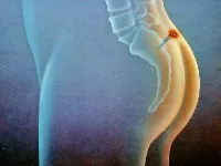 Epithelialis farkcsíkcsonti kúra műtét nélkül, kimetszése egy fotó, videó (epithelialis farkcsíkcsonti) Epithelialis farkcsíkcsonti kúra műtét nélkül, kimetszése egy fotó, videó