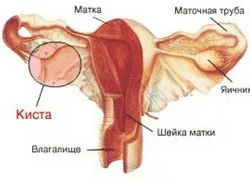 méhtest endometriózis