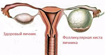 Endometrioid petefészek ciszta kezelés, a tünetek, okok (tünetek) Endometrioid petefészek ciszta kezelés, a tünetek, okok