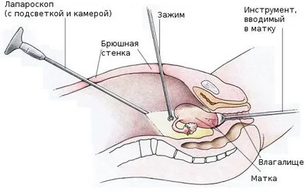 Endometrioid petefészek ciszta okok, tünetek és a kezelés (oka) Endometrioid petefészek ciszta okoz, tünetek és a kezelés