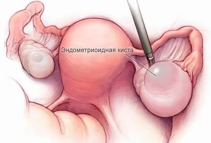 Endometrioid petefészek ciszta - az okok, kezelések, a tünetek