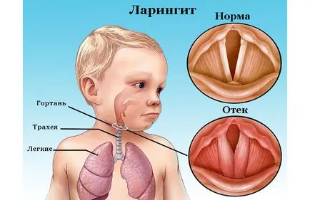 Как за лечение на ларингит при децата - най-добрият начин за бързо излекуване на детето