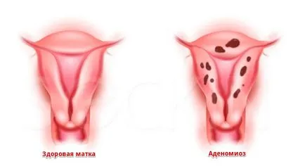 Ehopriznaki adenomyosis meg (adenomyosis) Ehopriznaki adenomyosis meg