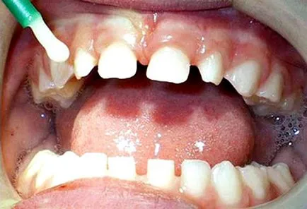 Fluoridálás vagy ezüst baba foga a gyermeknek, hogy jobb, ha választani