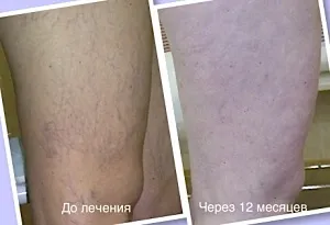 Капилярите на краката по някаква причина се спука и как да се премахне
