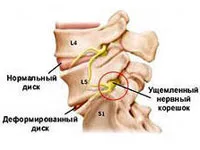 gerinc hemangioma kezelés, okai, tünetei és jelei