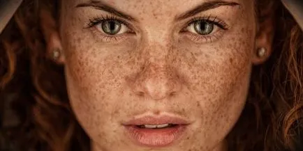 Hyperpigmentation kezelés, prognózis, tünetei, diagnózisa, okai