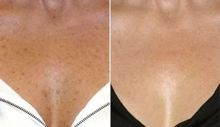 Hyperpigmentation okai, tünetei és kezelése