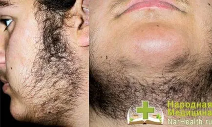 Hyperandrogenismus nőknél - tünetek, okok, kezelés mellékvese eredetű (nők) Hyperandrogenismus nőknél - tünetek, okok, kezelés mellékvese Genesis