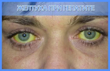 Hepatitis B és mi ez, és hogyan kerül továbbításra, a tünetek egy fertőző betegség, a diagnózis és a kezelés Botkin