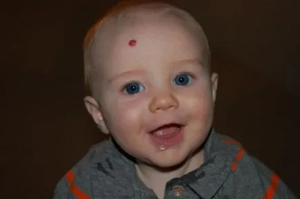 Hemangioma az újszülöttek (18 fotók) okoz, és kezelés, a fej és a fej hátsó részét a mell, arc,