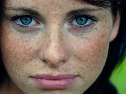 Hyperpigmentation okai, tünetei és kezelése