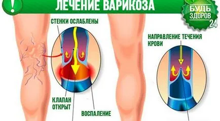 Лечение на разширени вени на народни средства - как да се отърве от разширени вени в страната