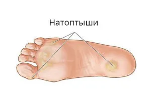 Мазоли по петите