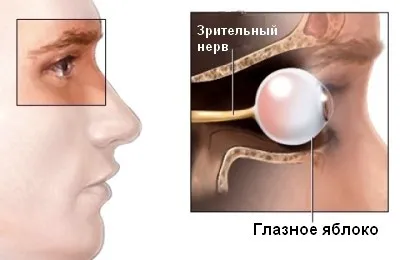 Неврит на зрителния нерв причини, симптоми, лечение