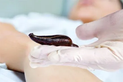Hirudotherapy, jelzések és ellenjavallatok (hirudotherapy) Hirudotherapy, jelzések és ellenjavallatok