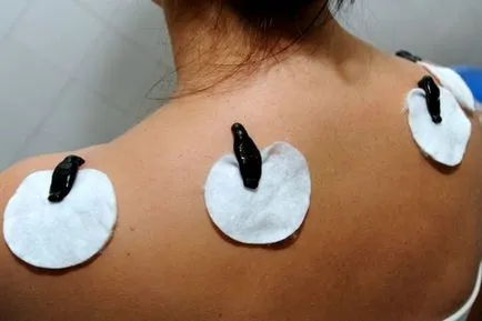 Hirudotherapy, jelzések és ellenjavallatok (hirudotherapy) Hirudotherapy, jelzések és ellenjavallatok