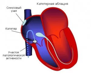 видове сърдечна операция и индикации