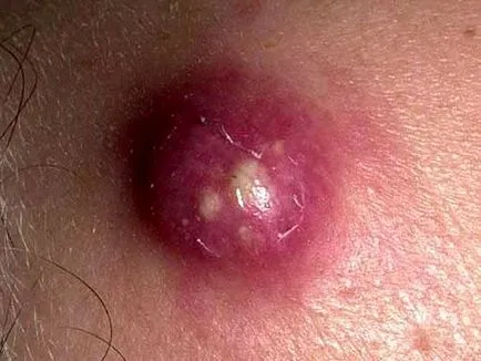 Основни принципи на лечение на циреи у дома (домашно цирей) Основни принципи циреи лечение у дома
