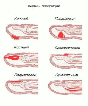 Престъпник пръстите на ръцете и краката - колко бързо лекува възпаление и предотвратяване на усложнения