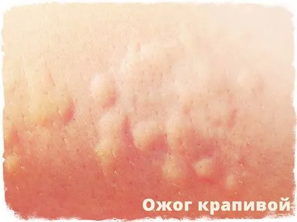 Стинг - ефекти и първа помощ