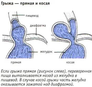 nyelőcső sérv kezelési népi jogorvoslati (nyelőcső) nyelőcső sérv kezelési népi jogorvoslati