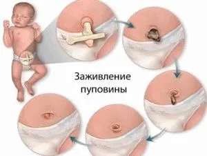 Пъпната рана при кърмачета - как да се справя раната и кога ще се излекува