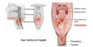 Компреси гърлото предизвиква чувство на стягане или хриптене