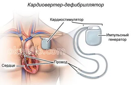 Синдромът на ранното камерна реполяризация какво е проява на ЕКГ