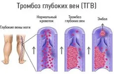 Церебрални симптоми и лечение вазоспазъм (формулировки, таблетки)