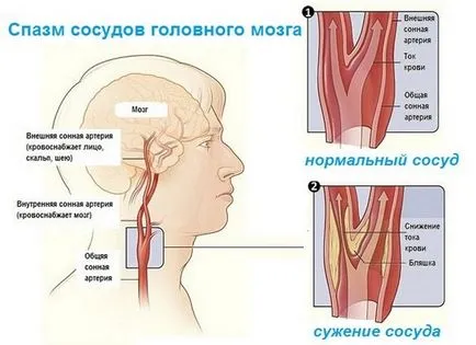 Церебрални симптоми и лечение вазоспазъм (формулировки, таблетки)