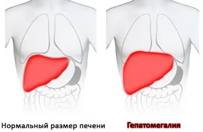 Увеличен черен дроб причини и лечение, какво да правят в такива случаи