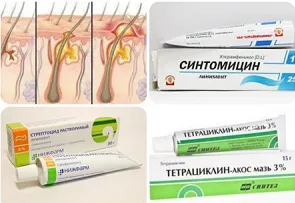 Изберете най-добрата мехлем за пъпки и черни точки по лицето